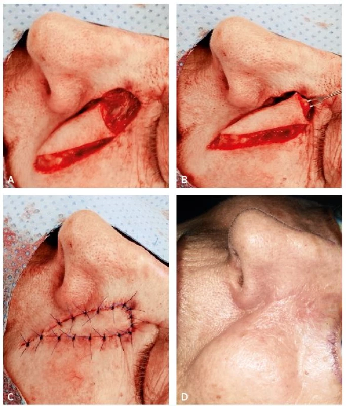 A–D. Sequence of reconstruction of defect on the nasal-cheek border with V-Y advancement nasolabial flap