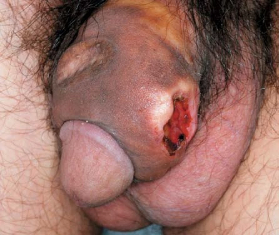 Nehojící se ulcerované ložisko po injekční aplikaci borové masti
Fig. 4. Non-healing ulcerated lesion after injection application of the boric ointment