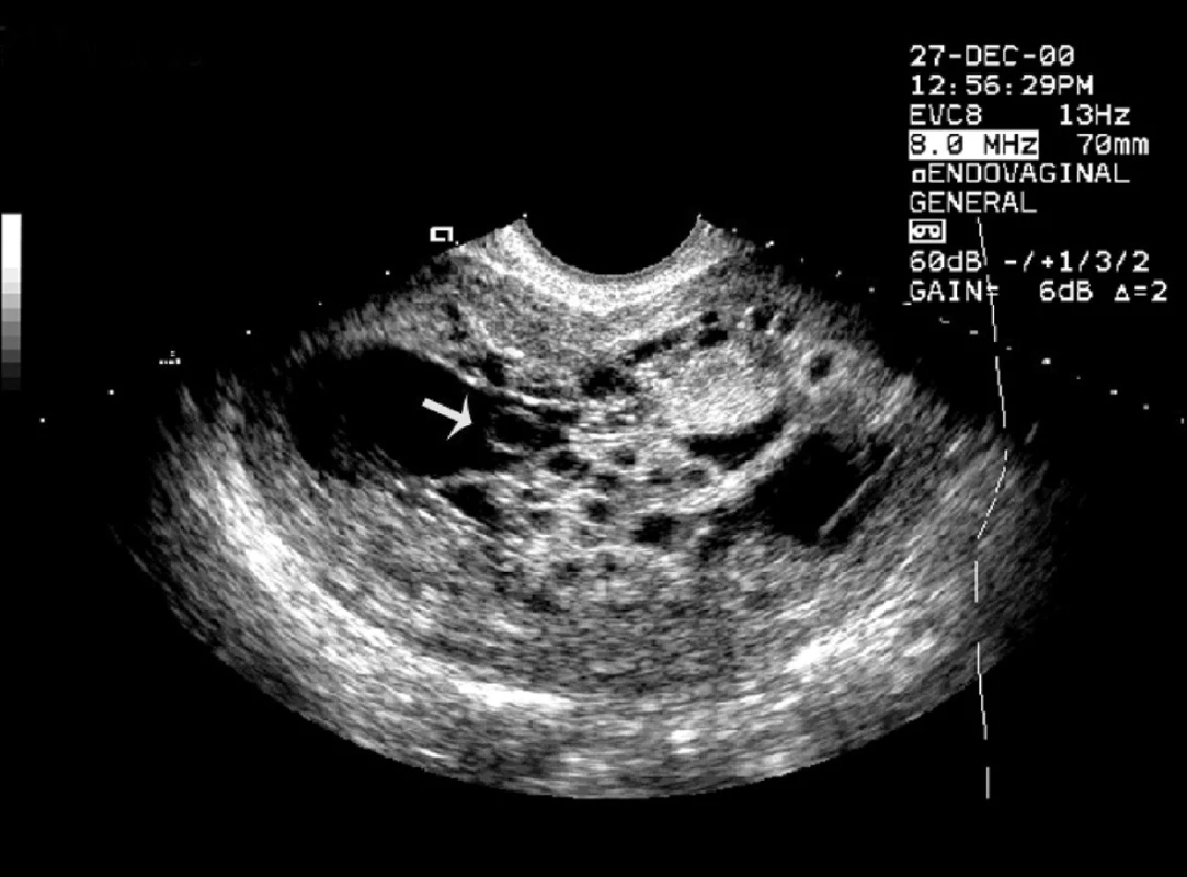 Mola partialis - gr. hbd. 6 – šipka znázorňuje žloutkový váček lokalizovaný v choriové dutině atypického tvaru