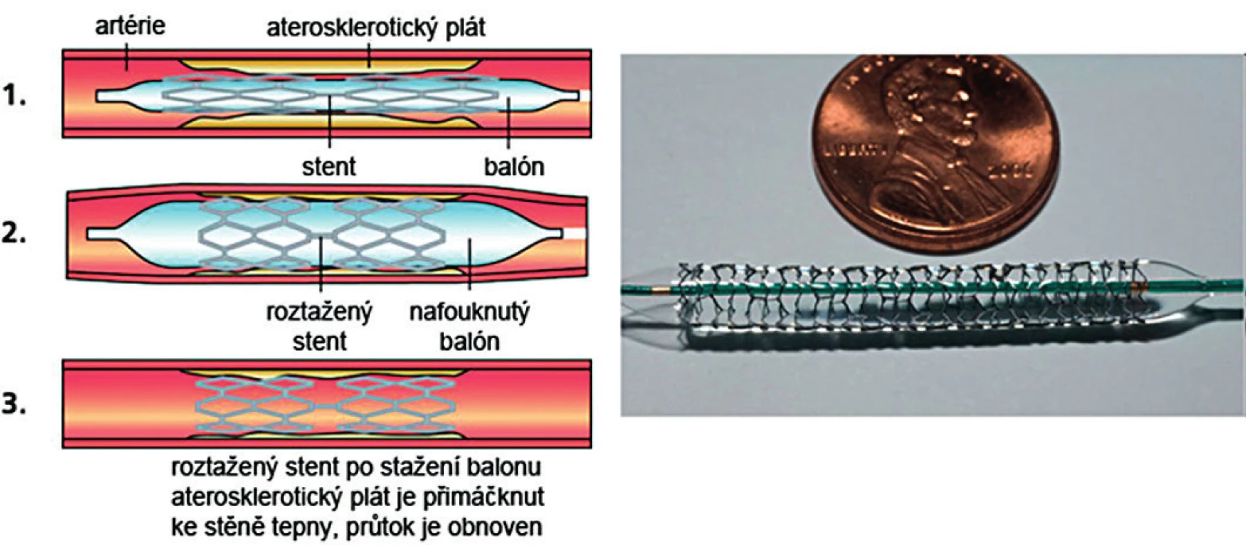 Koronární stent a jeho funkce při angioplastice, vpravo pak skutečná velikost a architektura stentu