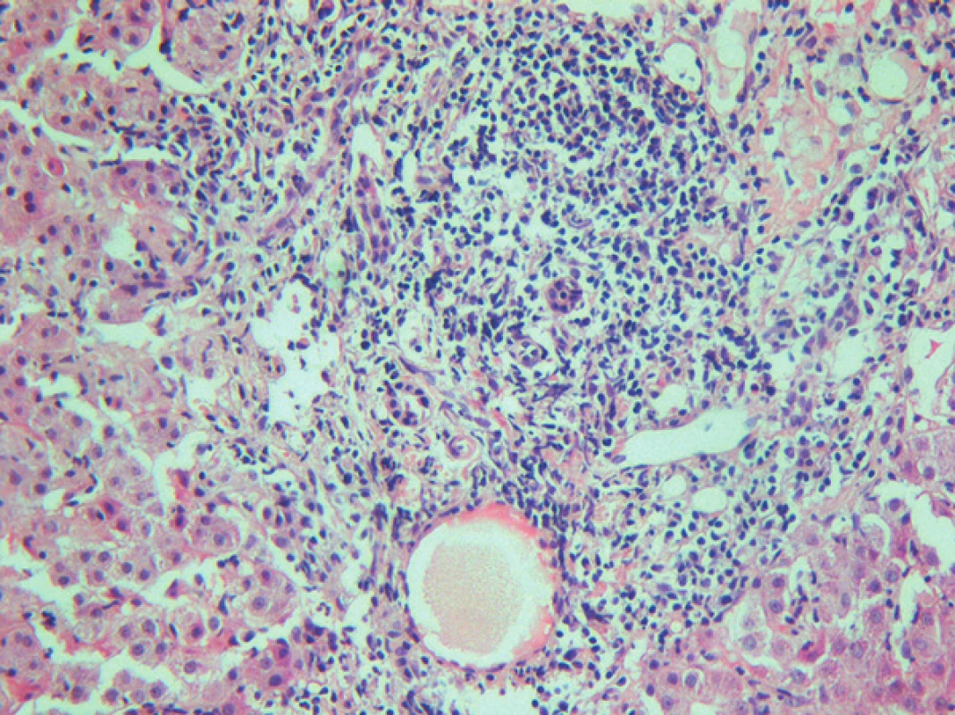 Autoimunní hepatitida. Portální pole s fibrózou, edémem a smíšenou, převážně lymfoplazmocytární infiltrací s výraznou interface aktivitou. Barvení: H&amp;E, zvětšeno 200x.