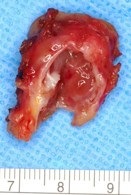<i>Multilokulární cystická renální neoplaziebnízkého maligního potenciálu</i>
Fig. 2.<i>Multilocular cystic renal neoplasm of lowbmalignant potential</i>