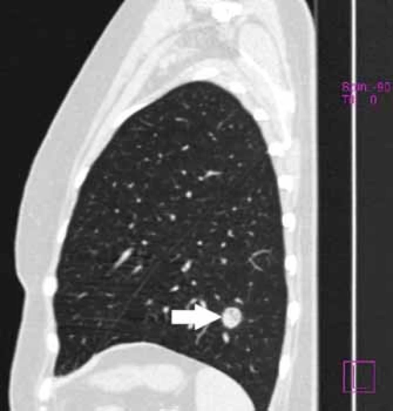 Bílá šipka – 15mm tumor v oblasti levé plíce.
Fig. 2. White arrow – 15mm tumour in left lung lobe.