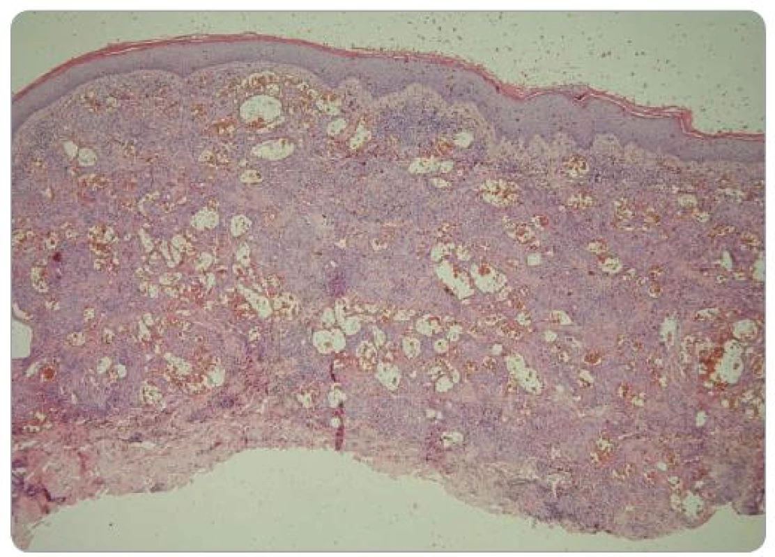 Histologický obraz léze na zadní straně levého stehna. Celé korium je prostoupeno nepravidelnými krevními cévami, v jejichž okolí je zánětlivý infi ltrát (HE, zvětšení 40krát). 
Foto: doc. MUDr. L. Pock, CSc.