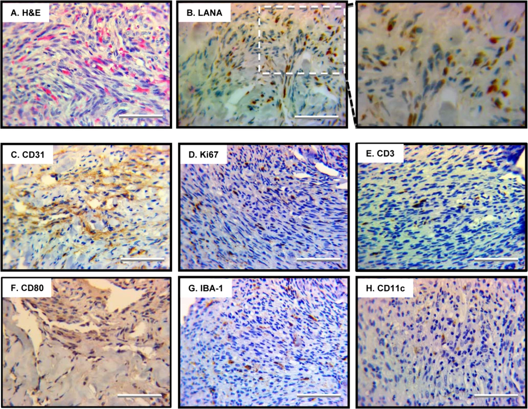 Angiogenic and inflammatory features of human Kaposi’s sarcoma.