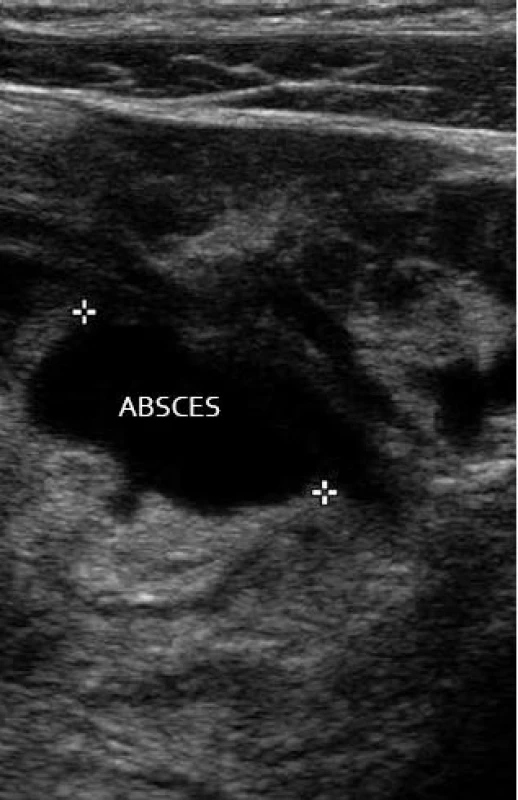 Komplikace divertikulitidy – mezikličkový absces.
Fig. 13. Complications of diverticulitis – interloop abscess.