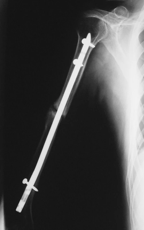 RTG obraz pakloubu diafýzy pažní kosti po nitrodřeňové osteosyntéze hřebem UHN
Pic. 4. X-ray of the pseudoarthrosis of humeral shaft fracture after intramedullar nailing