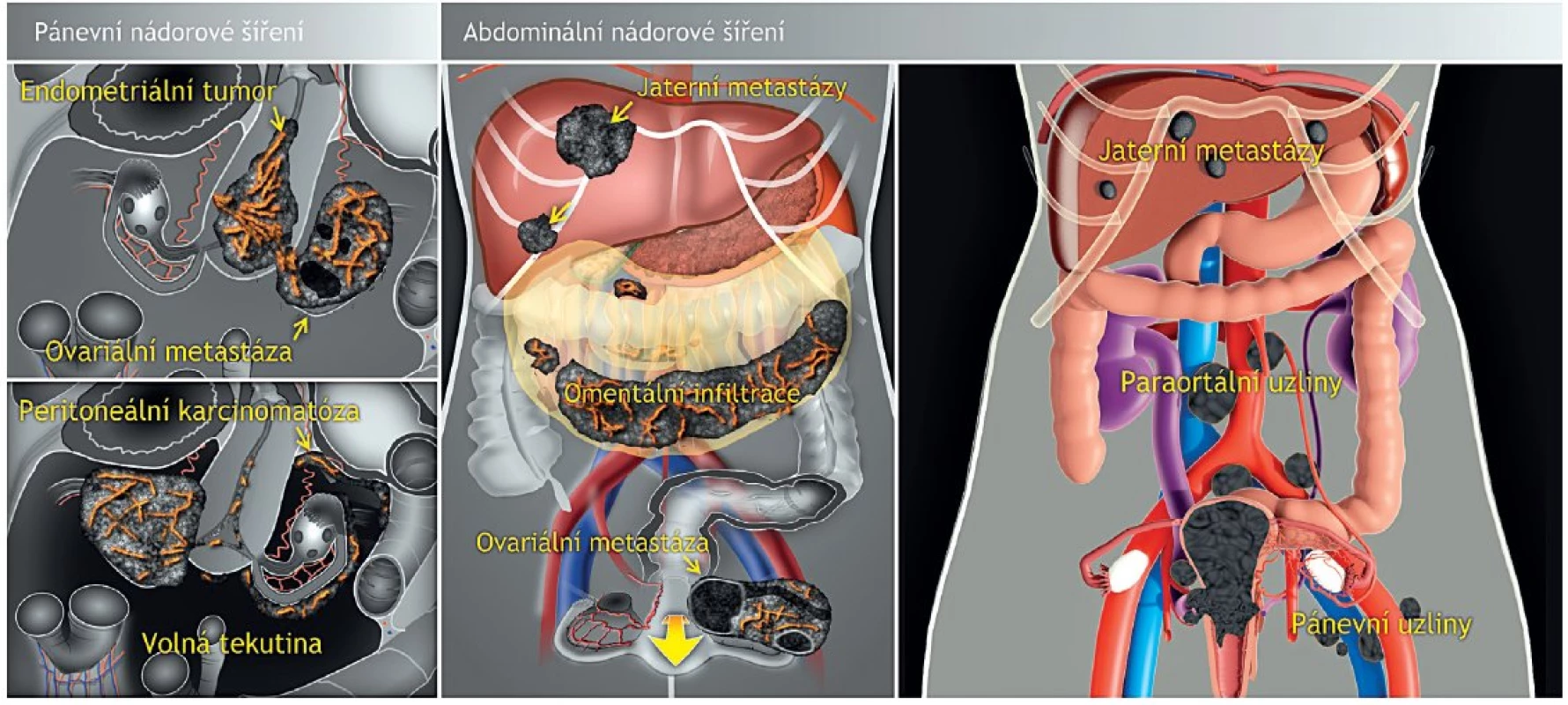 Ultrazvukové hodnocení extrauterinního šíření endometriálního karcinomu kombinací transvaginálního a transabdominálního přístupu
