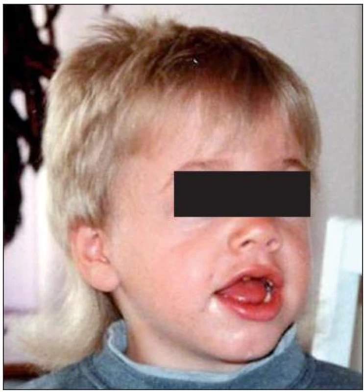 Kraniofaciální dysmorfie u pacienta s MPS I.
Fig. 1. Craniofacial dysmorphia in a patient with MPS I.
