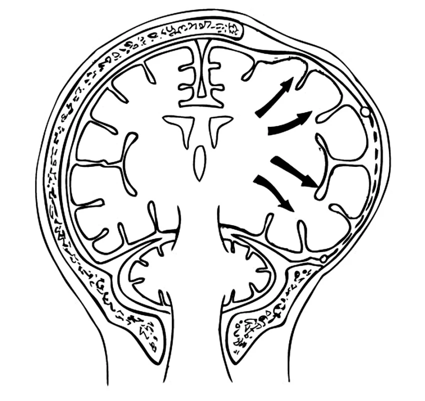Dostatečný rozsah dekompresivní kraniotomie uvolní mozkovou hemisféru bez sekundárního poškození
Pic. 9. Sufficient extent of the decompression craniotomy procedure releases the cerebral hemisphere without any secondary damage.