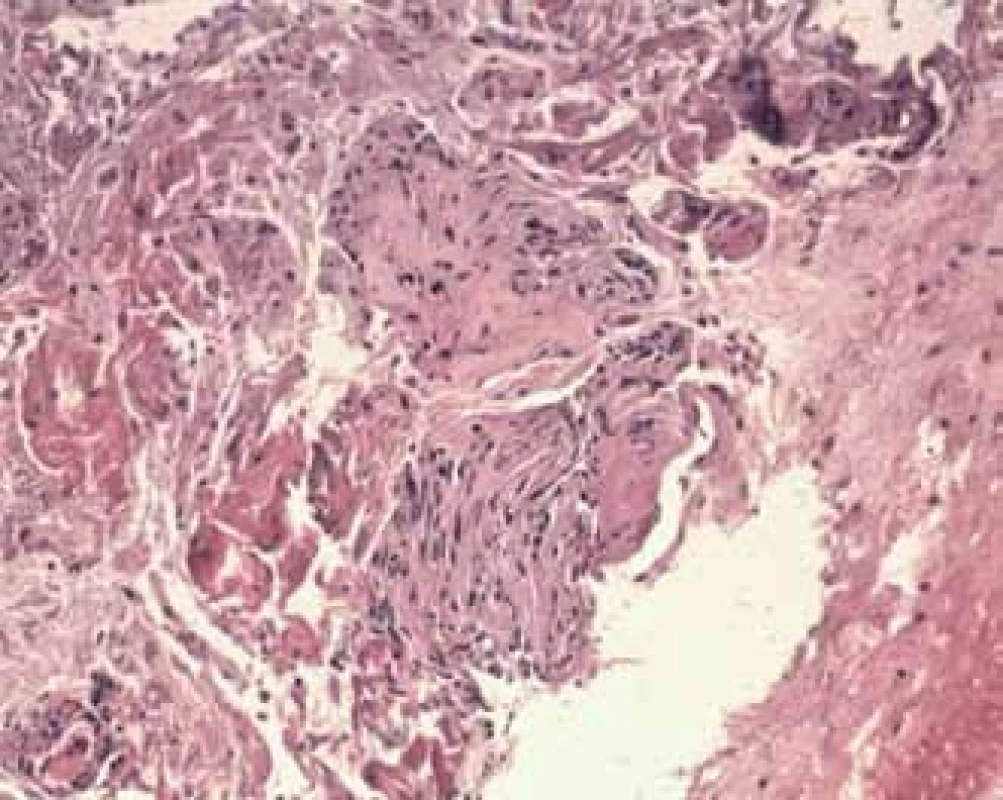 H &amp; E ,400× cytologický obraz po EUS-FNA (atypické lymfoidní buňky). Exprese CD 20, LCA, bcl2, CD 3,5.