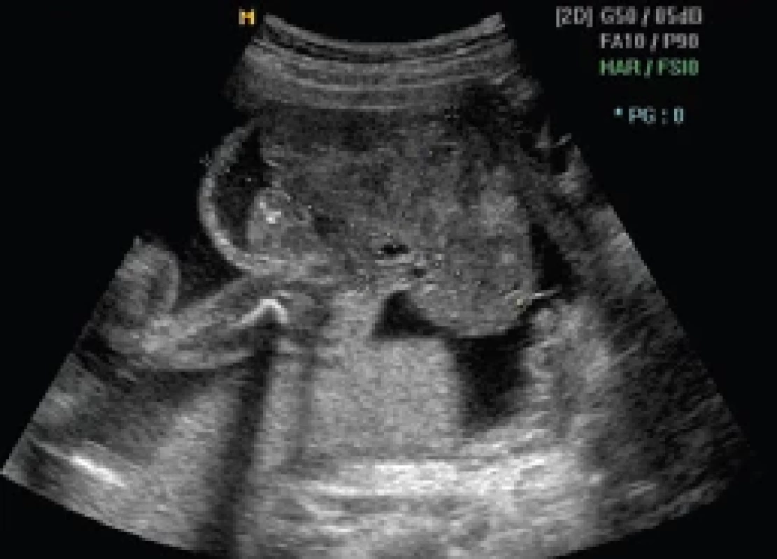 Sakrokokcygeální teratom, ultrazvukový nález ve 20. týdnu gestace. </br>Fig. 2. Sacrococcygeal teratoma, ultrasound fi nding at 20 weeks of gestation.