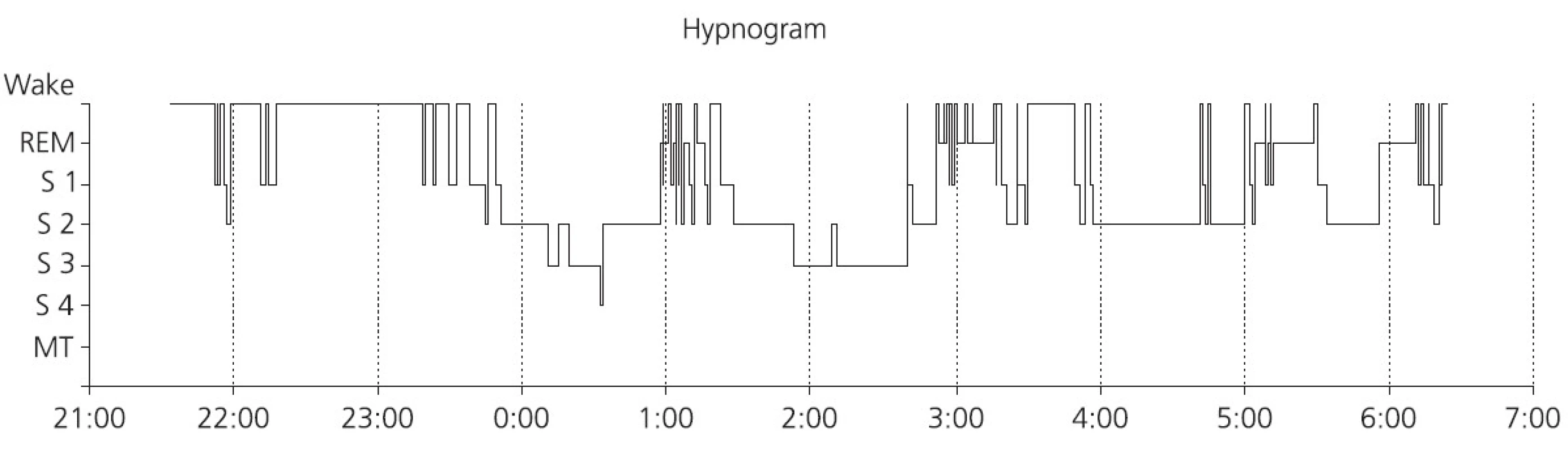 Hypnogram nemocného s obstrukční spánkovou apnoí, která se vyskytuje u tohoto nemocného více v REM spánku. Patrný velký podíl bdělosti během spánku, dlouhá latence kontinuálního hlubokého NREM spánku a velká fragmentace REM spánku. Podíl trvání REM spánku je zkrácen na 12 %. Hluboký NREM spánek tvoří jen 13 % celkové doby spánku. Cyklické uspořádání spánku je však zachováno.