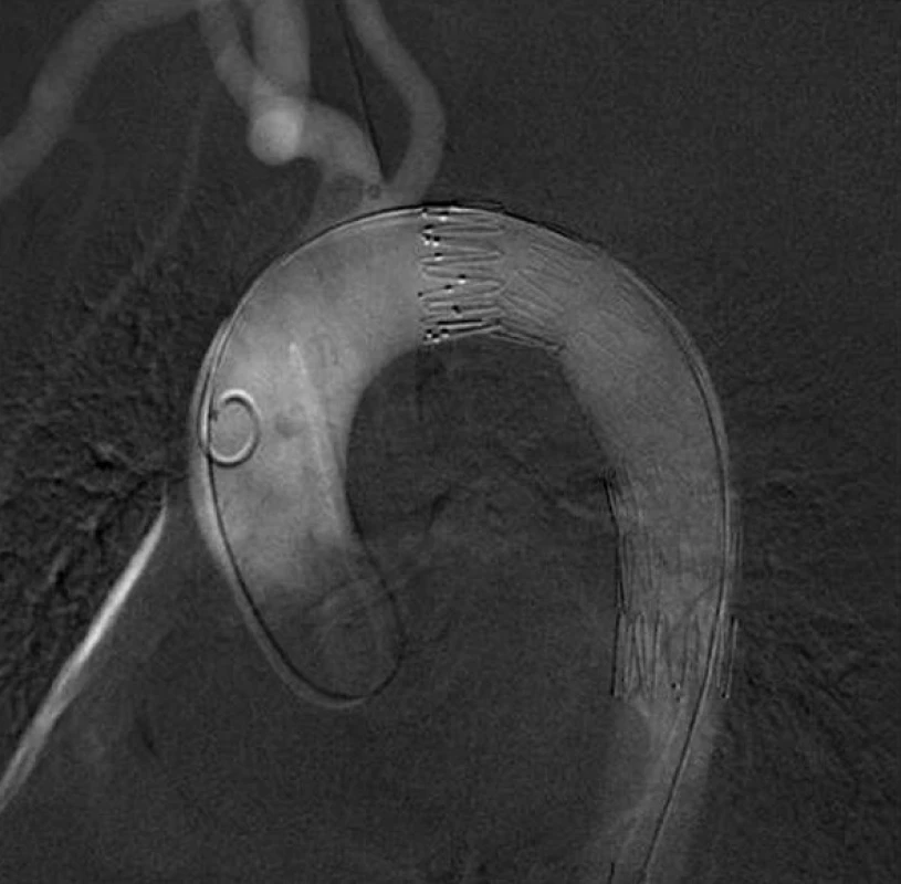 Digitální subtrakční arteriografie- finální uložení endograftu
Fig. 2: Digital subtraction angiography – the final endograft position