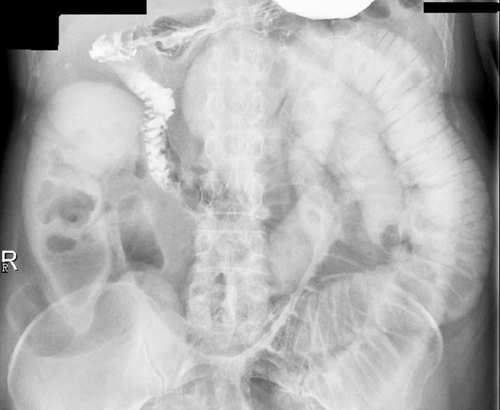 RTG snímek 3,5 hodiny po podání kontrastní látky
Fig. 3. X-ray view at 3.5 hours following administration of the contrast