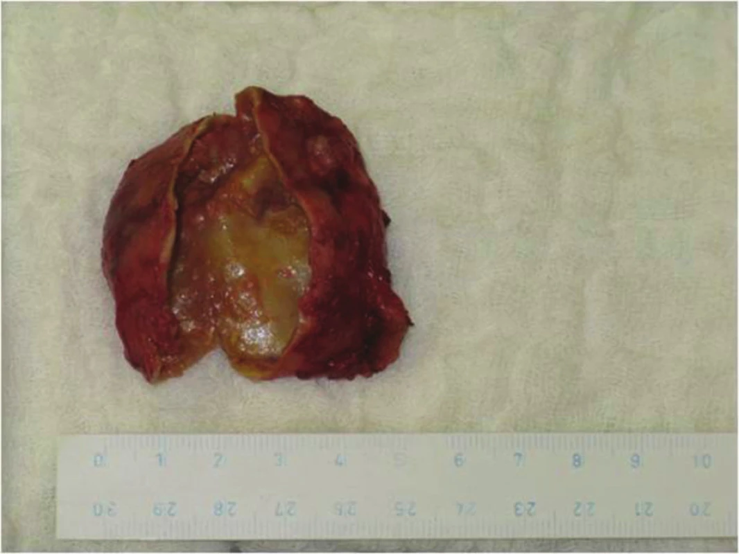 Rozstřižený preparát příštítného adenomu
Fig. 5: Cut preparation of the parathyroid adenoma