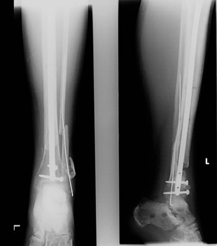 Konverze na intramedulární osteosyntézu pomocí expert tibial nail
Fig. 7: Conversion to intramedullary osteosynthesis using expert tibial nail