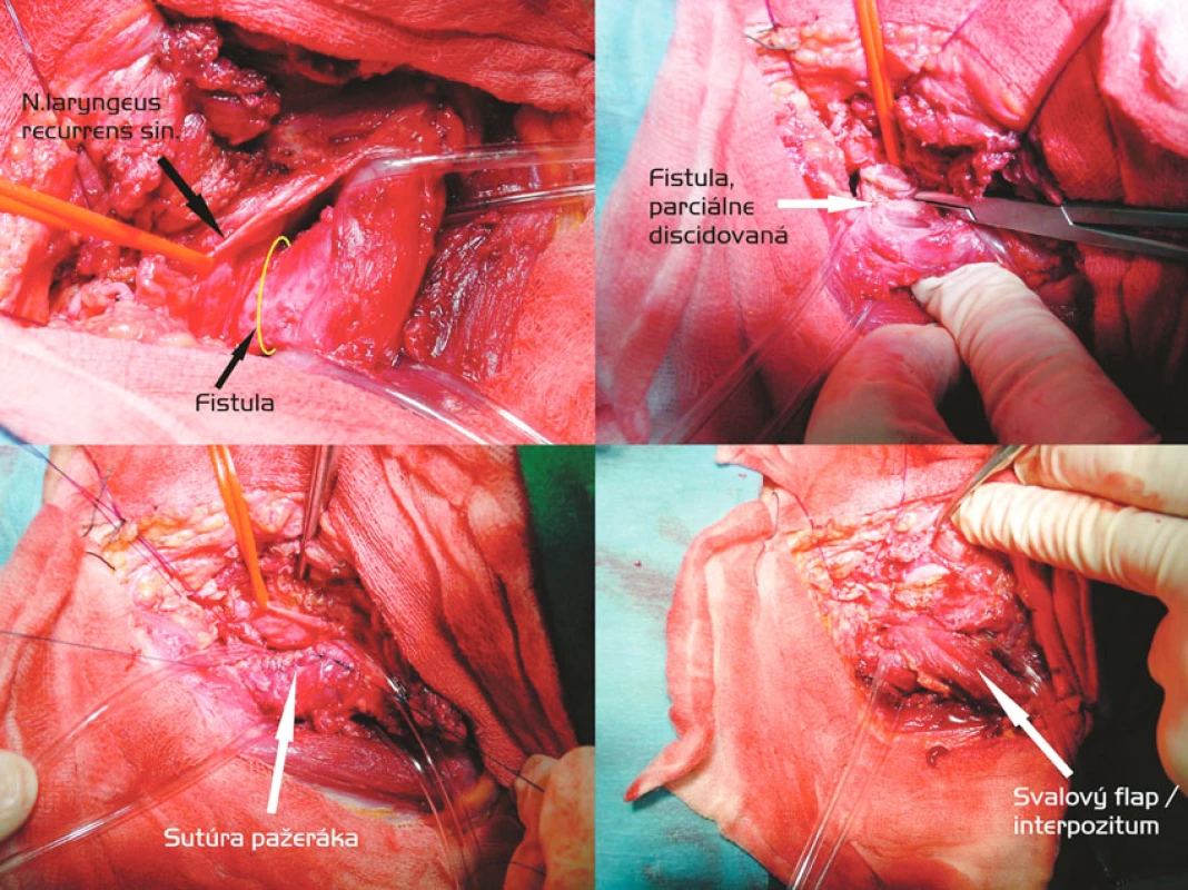 Discízia fistuly, sutúra membranacey trachey a dvojvrstvová sutúra pažeráka, svalové interpozitum (časť m. sternocleidomastoideus). Postup zľava doprava, zhora nadol
Fig. 3. Discission of fistula, suturing of the tracheal membranacea and a double-layer esophageal suture, muscle interposition (a part of the SCM – m. sternocleidomastoideus). Left to right and top to down