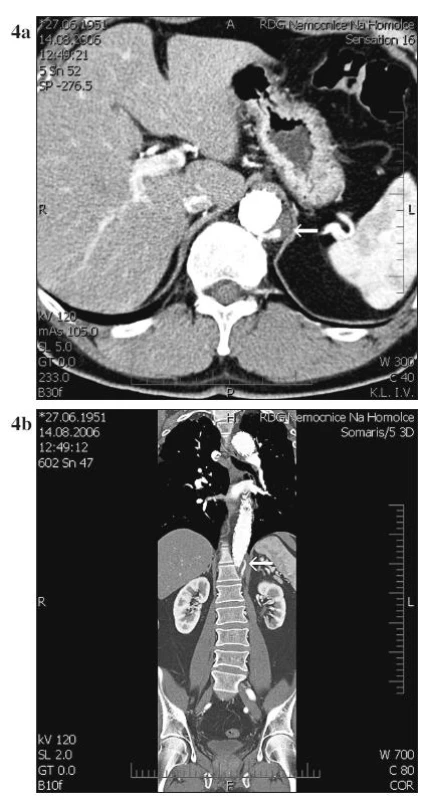 a, b. Retrográdní plnění falešného lumen k průchodné a. intercostalis
Fig. 4a, b. Retrograde filling of the false lumen into the patent intercostal artery