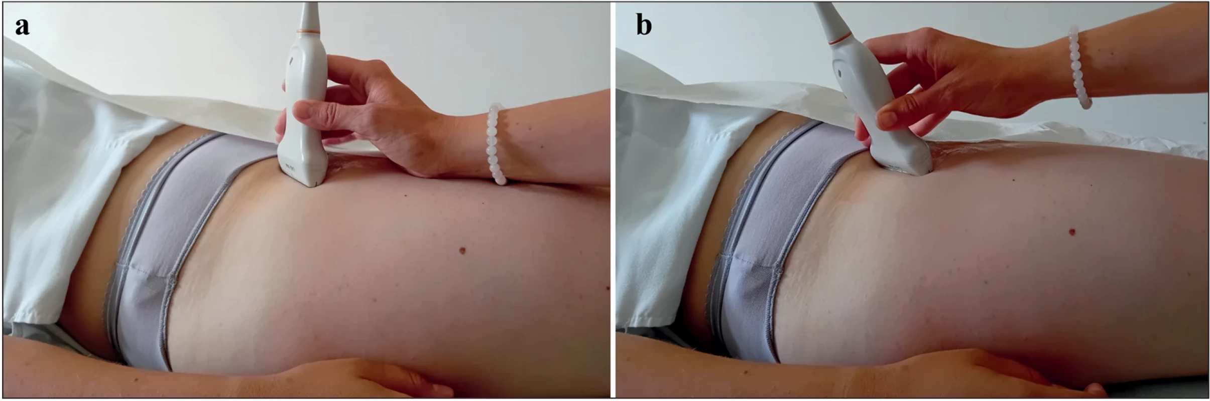 Ultrazvuková sonda přiložena nad kyčelním kloubem v ose krčku femuru. Náklon vůči povrchu pro vyšetření:  a –  ventrální části krčku femuru, b – ventrolaterální části krčku femuru. Fig. 5. Ultrasound probe placed above the hip joint along the axis of the femoral neck. Tilting of the probe surface for the  examination of: a – anterior part of the femoral neck, b – anterolateral part of the femoral neck.