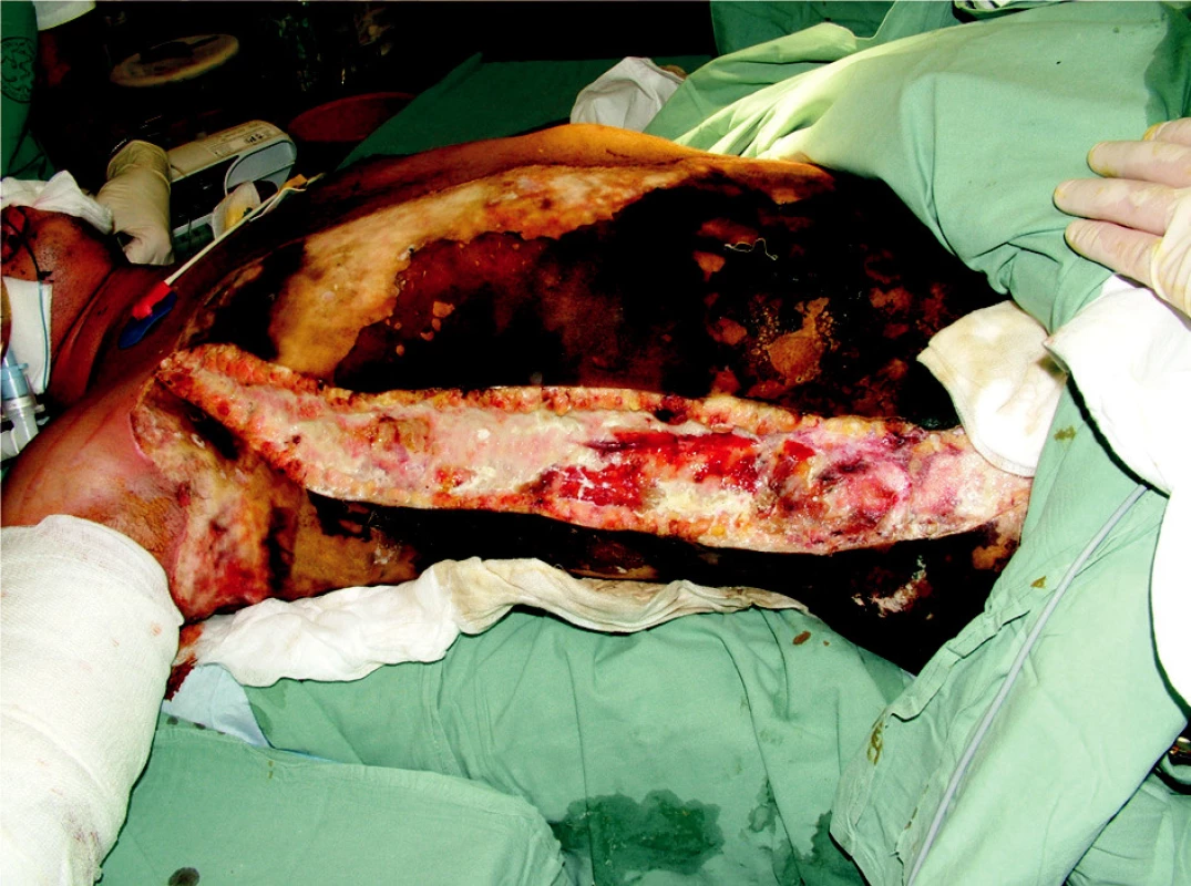 Releasing incision on chest