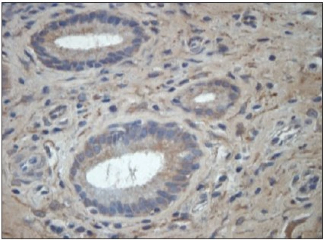 HBD 2 byl opakovaně zachycen v bazální oblasti povrchového víceřadého cylindrického epitelu polypózní sliznice s prokázanou přítomností Staphylococcus pyogenes aureus. Imunoperoxidázová reakce (DAB). Obj. 63x.