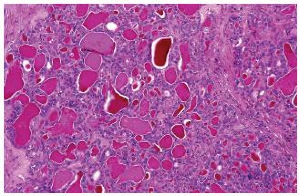 „Thyroid-like follicular“ RK může být složen převážně z makrofolikulárních elementů.