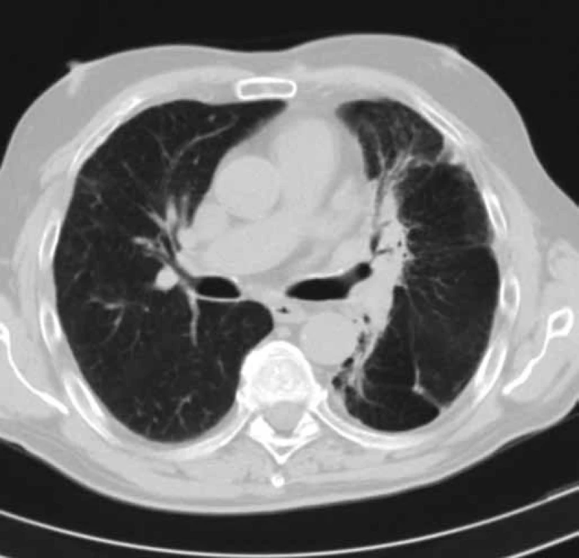 CT hrudníku pacienta č. 2 v době probíhající léčby erlotinibem (duben 2013).
Obrázek zobrazuje částečné zmenšení velikosti tumoru levé plíce a téměř úplné vymizení dys-/atelektatických změn dolního laloku levé plíce. Efekt léčby erlotinibem – parciální regrese.