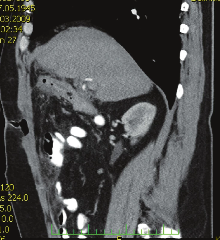 CT vyšetření břicha s nálezem defektu v břišní stěně se vzduchem
Fig. 2. Abdominal CT examination showing an abdominal wall defect with air