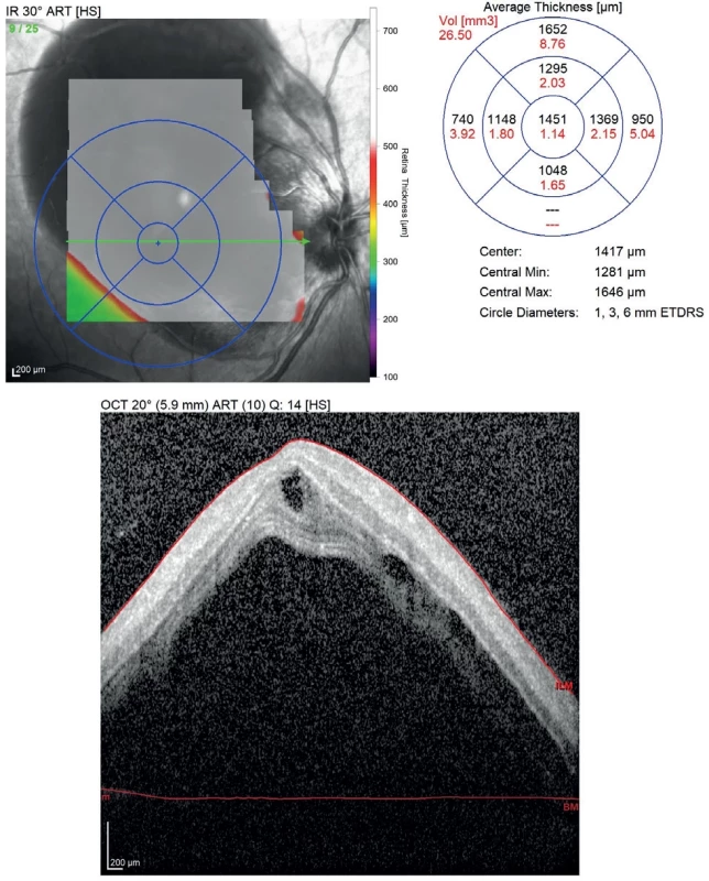 OCT scan of the right eye obtained at the time of diagnosis of exudative retinal detachment. The OCT image shows a significant amount of subretinal and intraretinal fluid