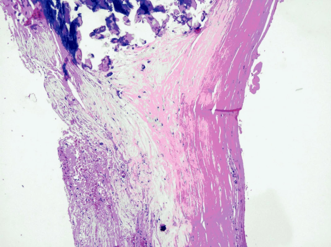 Histologický obraz stěny aneuryzmatu lienální tepny
Fig. 5. Histological findings of the aneurysmal wall of the lienal artery 