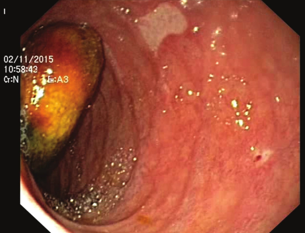 Endoskopie s nálezem žlučového kamene v sestupné části duodena
Fig. 2: Endoscopy confirming the presence of a gallstone in the descending part of the duodenum