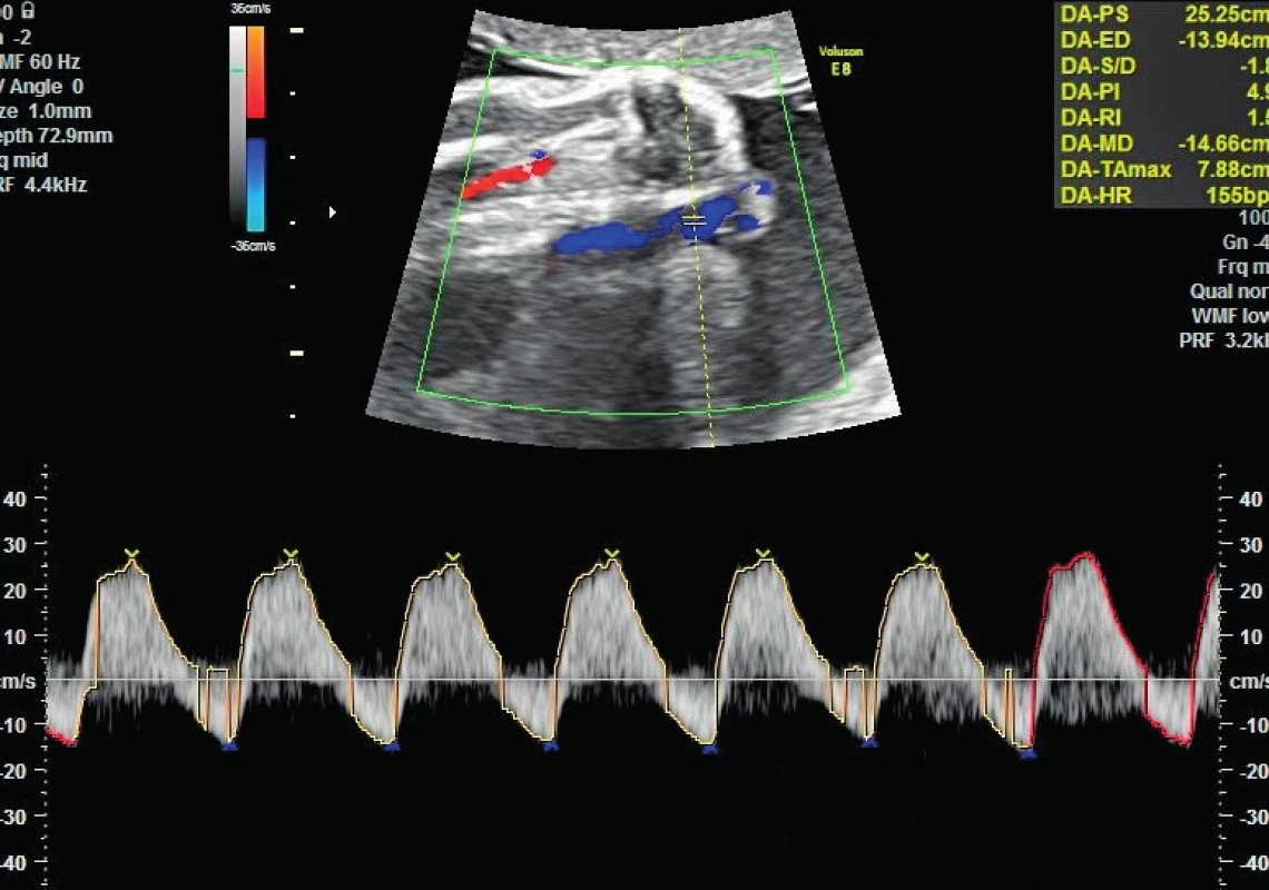 Revers flow v arteria umbilicalis