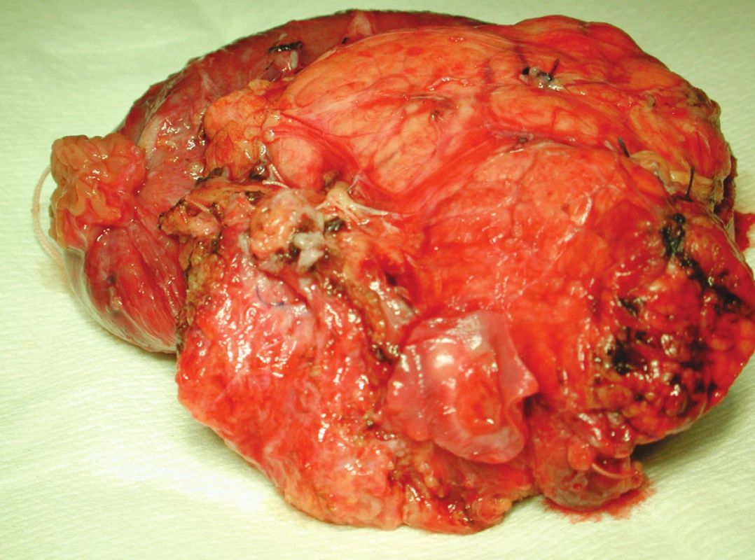 Resekovaná část hlavy slinivky břišní s prorůstáním tumoru do lumen cévy
Fig. 1. Aresected part of the pancreatic head with the tumor penetrating into the vascular lumen