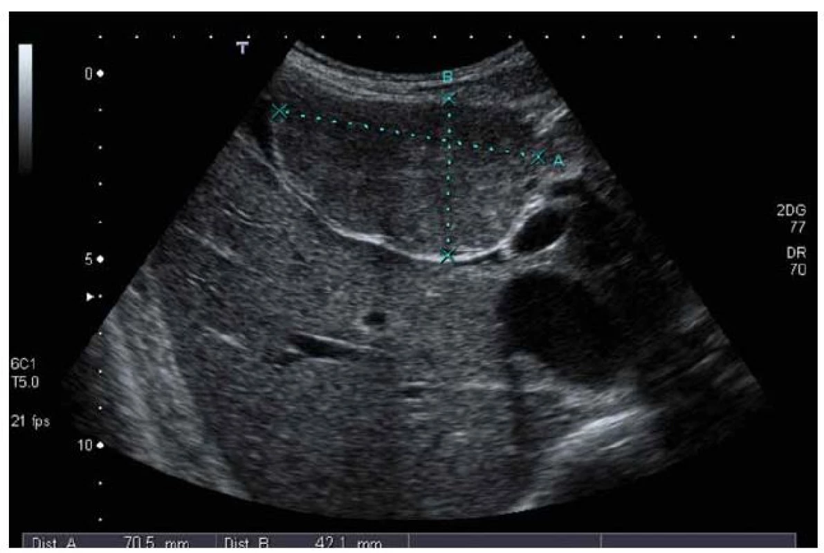 UZ vyšetření – ložisko FNH má stejnou echogenitu jako okolní jaterní parenchym, částečně se vyklenuje z jater.
Fig. 1. Ultrasound examination – FNH has the same echogenity as the surrounding liver parenchyma, FNH is partially outside the liver.