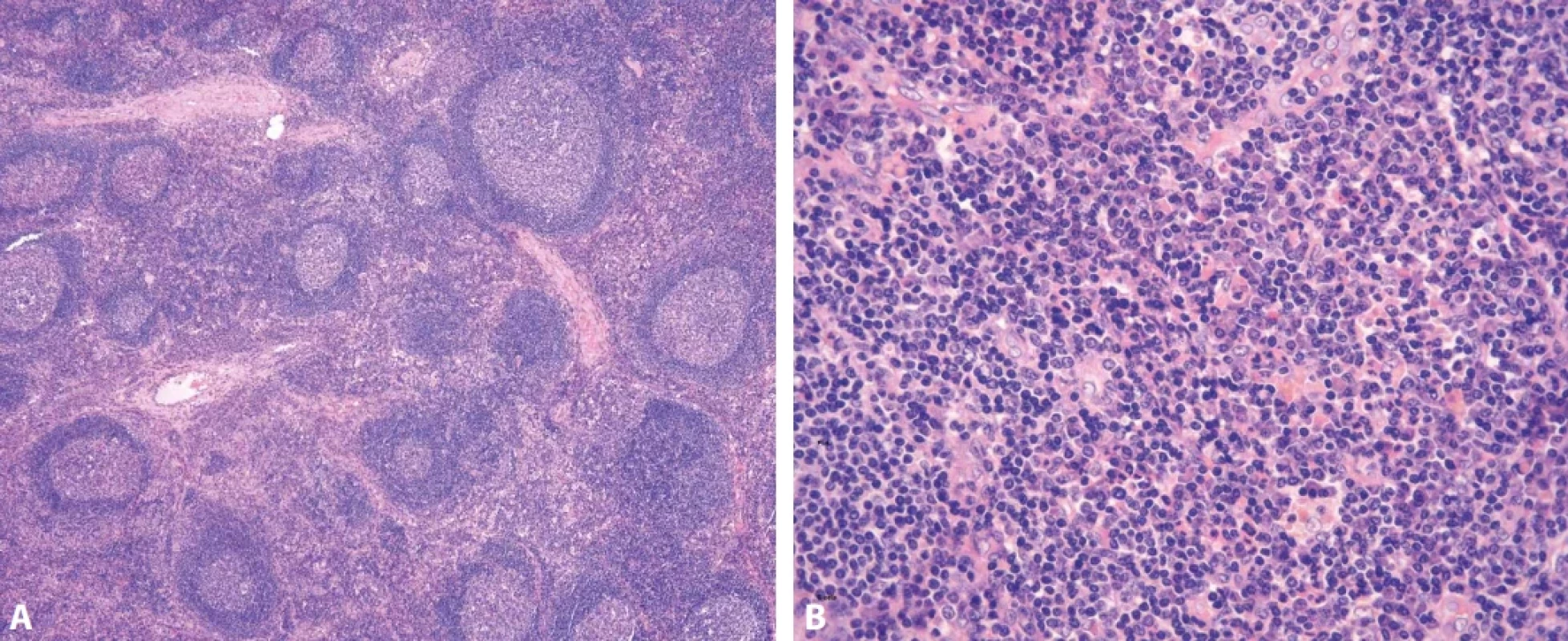 Plazmocytární typ morfologie. Zárodečná centra ve zmnožených folikulech jsou hyperplastická (A, hematoxylin-eosin, 40x). Interfolikulárně je nevýrazná proliferace cév a převaha plazmocytární infiltrace až plachtovitého charakteru (B, hematoxylin-eosin, 100x).
