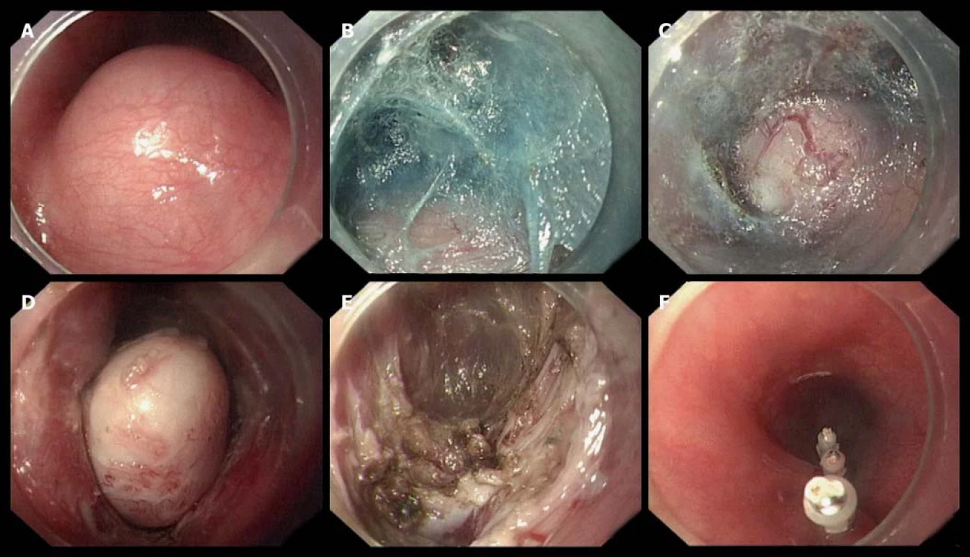 STER GIST v podání čínských expertů  (prof. Zhou [23]). Viditelný submukózní tumor původem vycházející z m. propria, dále incize sliznice a submukózní tunelizace, uvolnění nádoru od okolních tkání a resekce od m. propria a uzávěr defektu klipy.
Fig. 10. STER GIST presented by Chinese experts (Professor Zhou [23]). Visible submucosal tumour originating from m. propria, further incision of the mucosa and submucosal tunnelling, release of the tumour from the surrounding tissues and resection from m. propria followed by defect closure with clips.