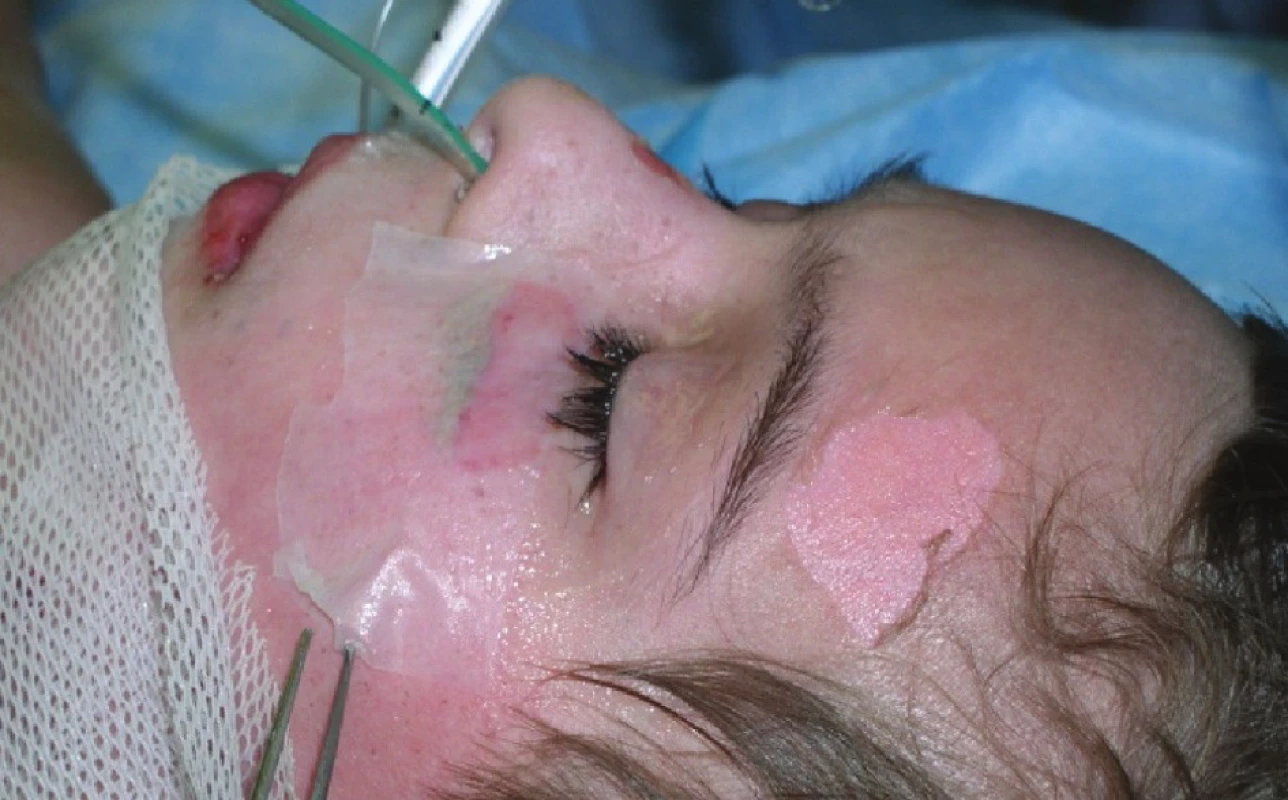 Exfoliované plochy na levé tváři a na čele – na levé tváři stp. přiložení Xe-Dermy
Fig. 8: Exfoliated areas on the left cheek and the forehead – the area on the left cheek following the application of Xe- Derma