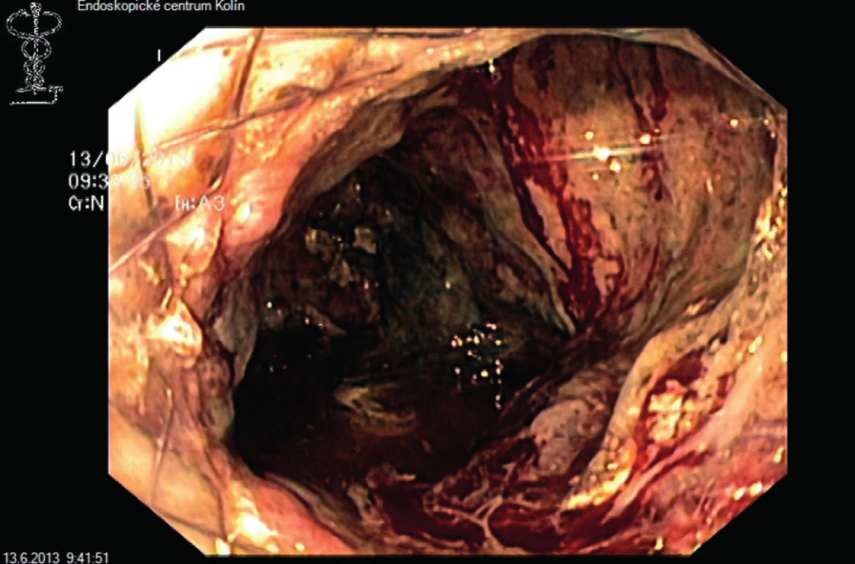 Videoasistovaná endoskopická perkutánní nekrektomie
Fig. 4: Video-assisted endoscopic percutaneous necrectomy