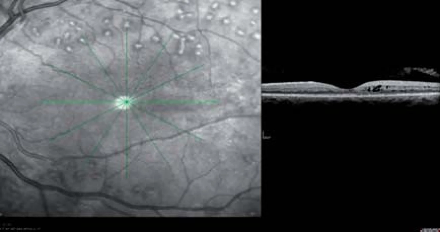 Diabetický edém makuly v OCT obraze pred a po intravitreálnej liečbe s antiVEGF ranibizumabom