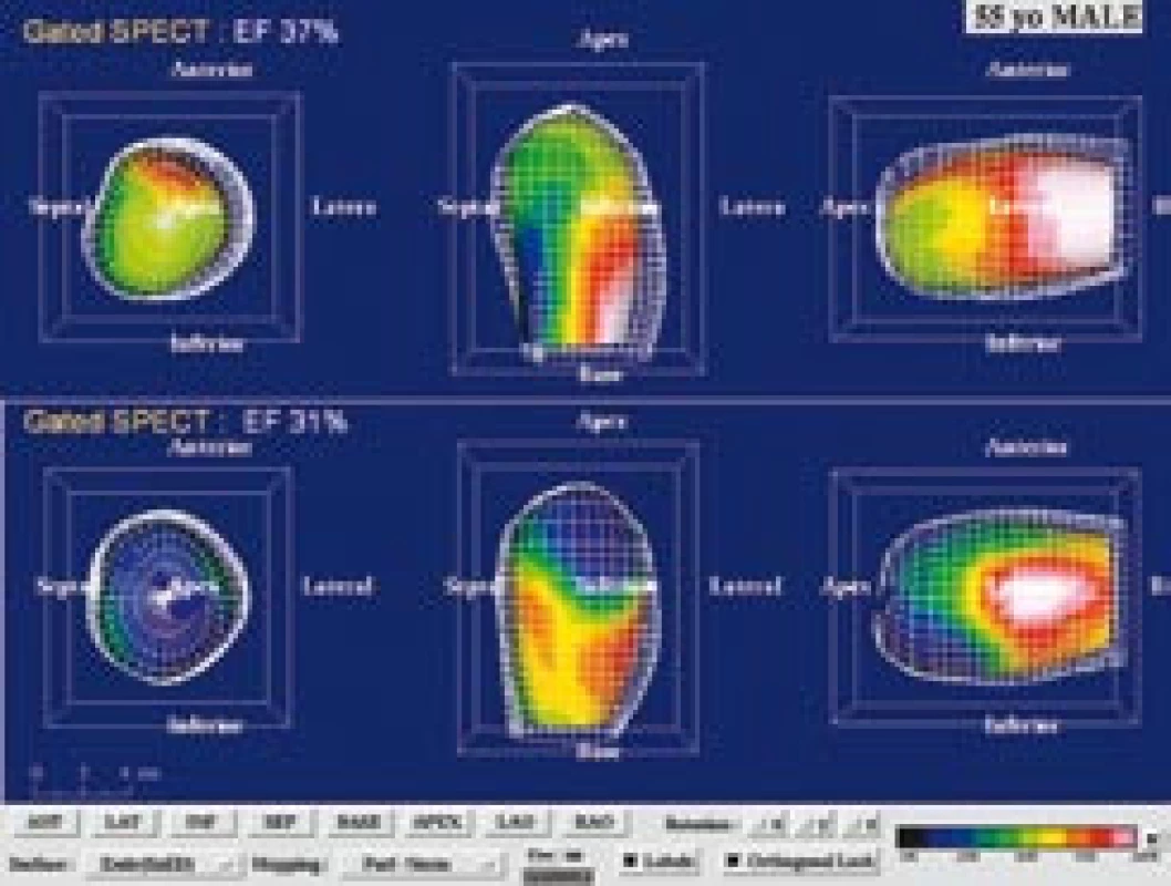 55letý muž s akutním anteroextenzivním infarktem myokardu léčeným direktní perkutánní koronární intervencí (PCI) na ramus interventricularis anterior. Po průkazu neviabilního myokardu (dobutaminovo u echokardiografií, SPECT a PET) byl pacient randomizovaně zařazen do kontrolního souboru v projektu zkoumajícím efekt buněk kostní dřeně na reparaci infarktového ložiska. (a) Na tomografických řezech po aplikaci <sup>99m</sup>Tc- MIBI SPECT a <sup>18</sup>F- FDG levé komory v horizontální dlouhé ose je zobrazen „perfuzně‑metabolický match“ (jizva) anteriorně, anteroseptálně a apikálně. (b) Kvantifikace na polárních mapách u téhož pacienta svědčí pro rozsáhlý neviabilní myokard tvořící 56 % z levé komory a 90 % z povodí ramus interventricularis anterior (LAD). (c) Gated SPECT 3D zobrazení endokardiálního povrchu v end‑di astole (ED) a end‑systole (ES). Při vstupním vyšetření (horní řádek) je patrná hypokinéza přední stěny, septa a hrotu. Objemy v ED a ES byly výrazně zvýšené (239 ml, resp. 151 ml) a EF snížena na 37 %. Při kontrole za 3 měsíce po PCI (dolní řádek) je patrné, že regionální kinetika se nezlepšuje, naopak dochází k poinfarktové remodelaci s nárůstem objemů v ED a ES (299 ml, resp. ESV 205 ml) a dalšímu snížení EF na EF 31 %.
