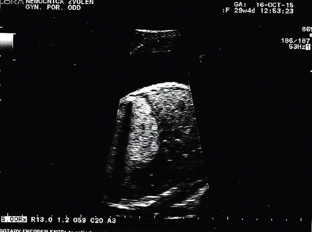 Parasagitálna rovina; tumor, srdce, bránica a hepar