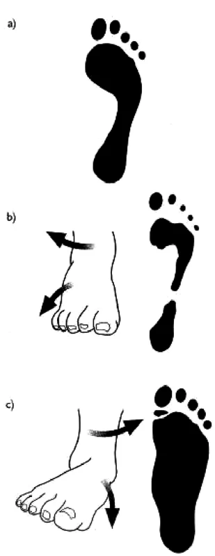 a) normální noha
b) nadmûrná supinace
c) nadmûrná pronace
