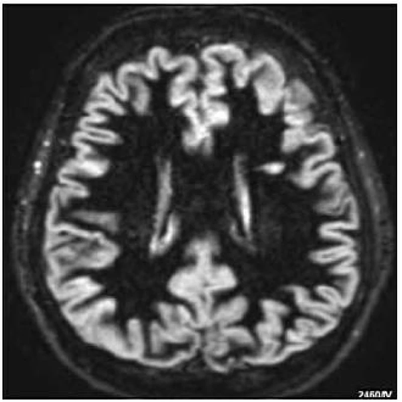 Sekvence DIR s patrnou lézí v oblasti bílé hmoty (MR dokumentace zapůjčena s laskavým svolením prof. MUDr. Zdeňka Seidla, CSc., MR odd. Radiodiagnostické kliniky 1. LF UK a VFN).