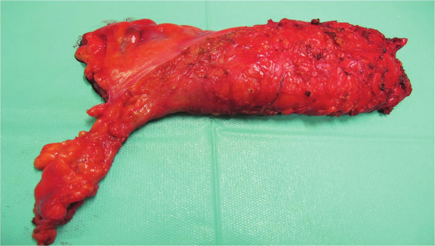 Kompletní TME (roboticky asistovaná resekce rekta) – fotografie resekátu
Fig. 1: Complete TME (robotic assisted LAR) – photo of the resection specimen