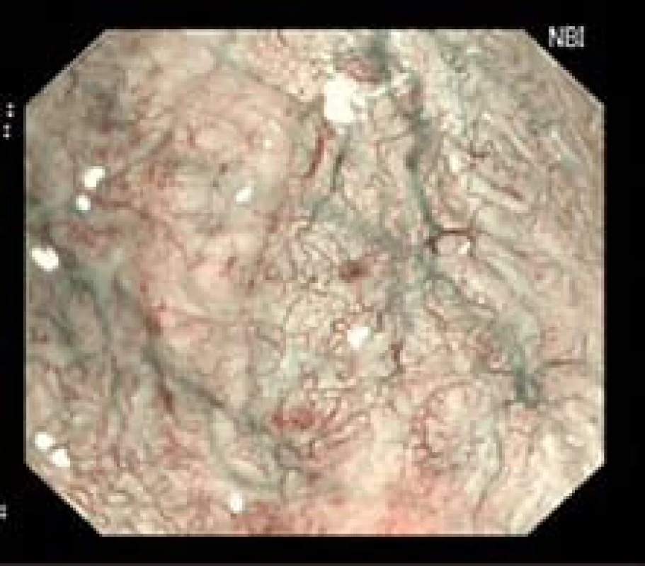 Patologická vaskulární kresba u LGD (NBI a ZOOM zobrazení).
Fig. 1. Irregular vessels in LGD (NBI, ZOOM).
