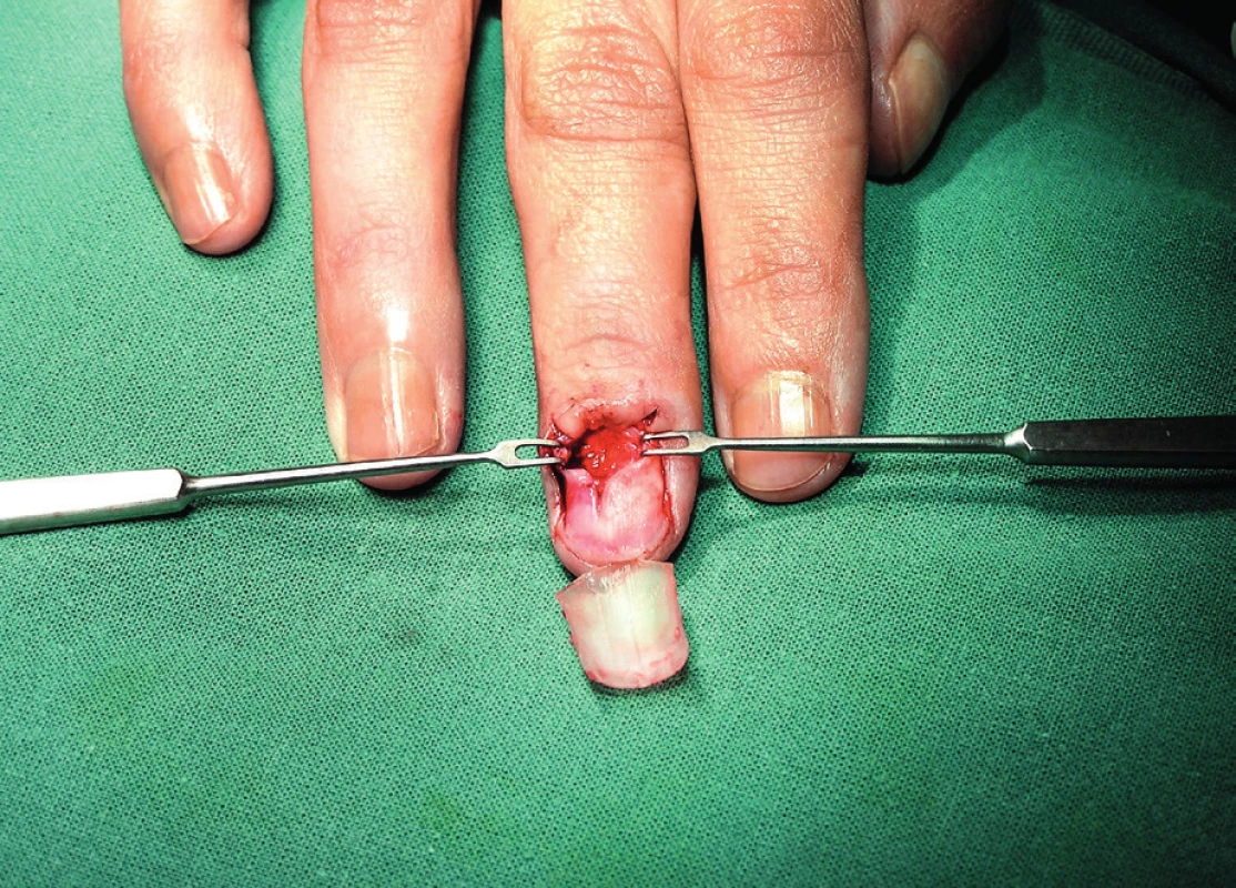 Nail bed after removal of the glomus tumor