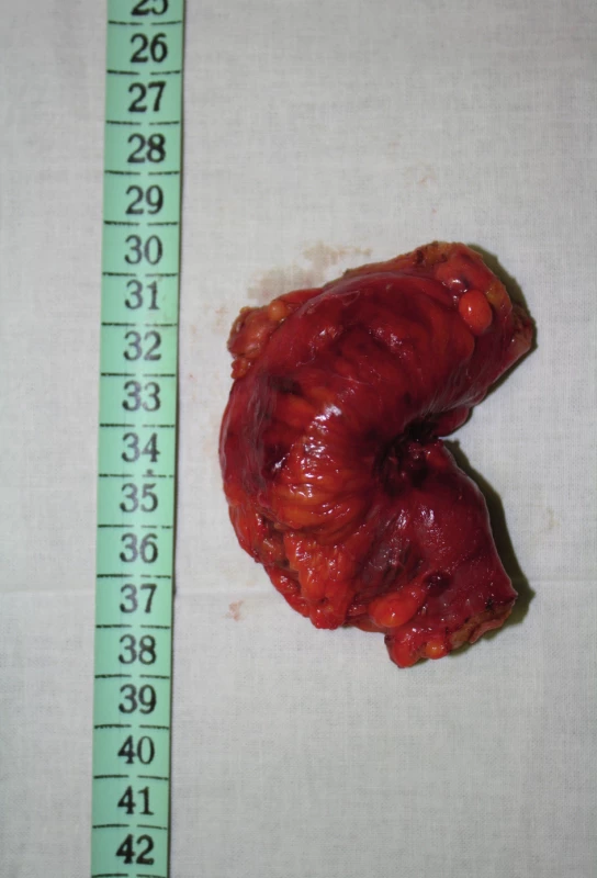 Resekát colon sigmoideum
Fig. 2: Excised part of the colon sigmoideum