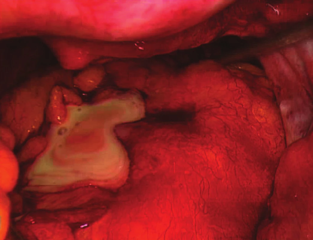 Peroperační nález u pacienta s abscesem v malé pánvi a purulentní peritonitidou
Fig. 1: Peroperative finding in a patient with a pelvic abscess and purulent peritonitis
