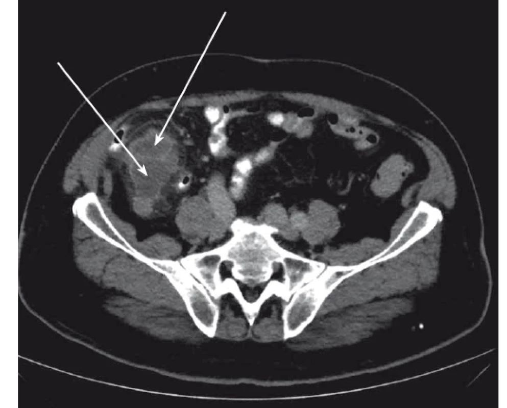 Dvě subcékální abscesové kolekce (šipky).
Fig. 2. Two subcecal abscess collections (arrows).